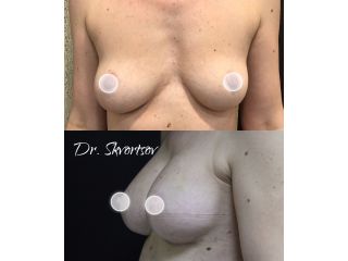 Увеличение груди анатомическими имплантами